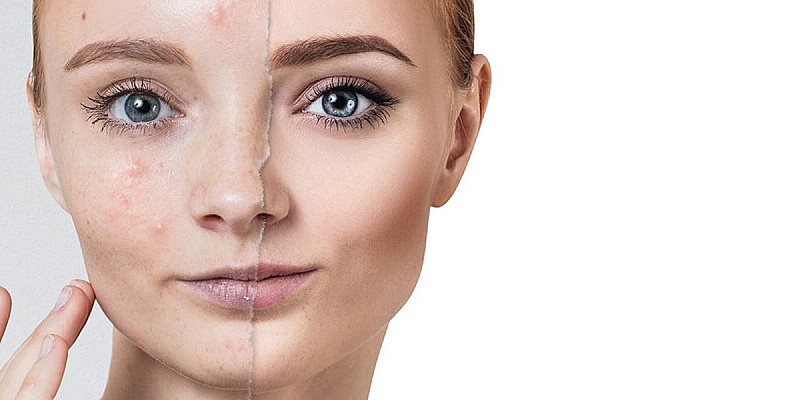 malattie-dermatologiche-infiammatorie