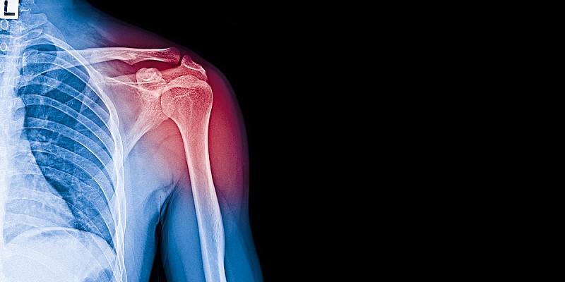 dolore tendini spalla