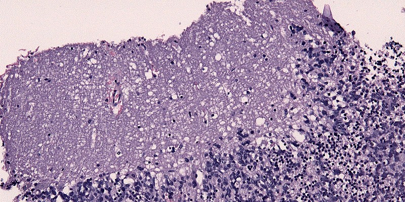 Medulloblastoma_cellule tumorali