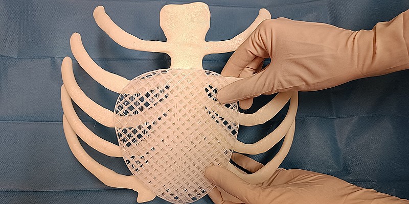 PROTESI 3D BIODEGRADABILE MONTATA SU MODELLO 3D PETTO ESCAVATO