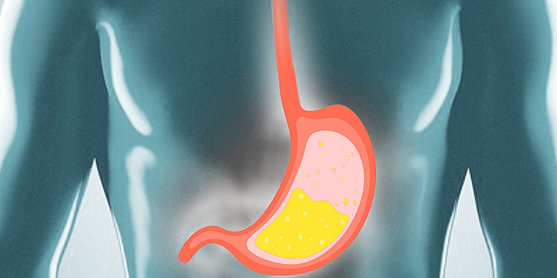 Reflusso-gastroesofageo