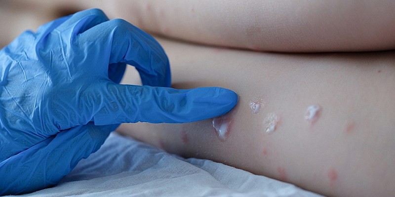 vaiolo delle scimmie