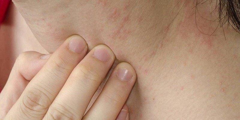 allergie-alimentari-cause-e-sintomi