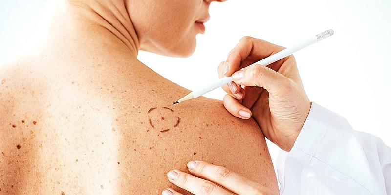 Melanoma