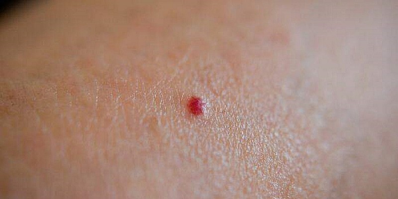 angioma