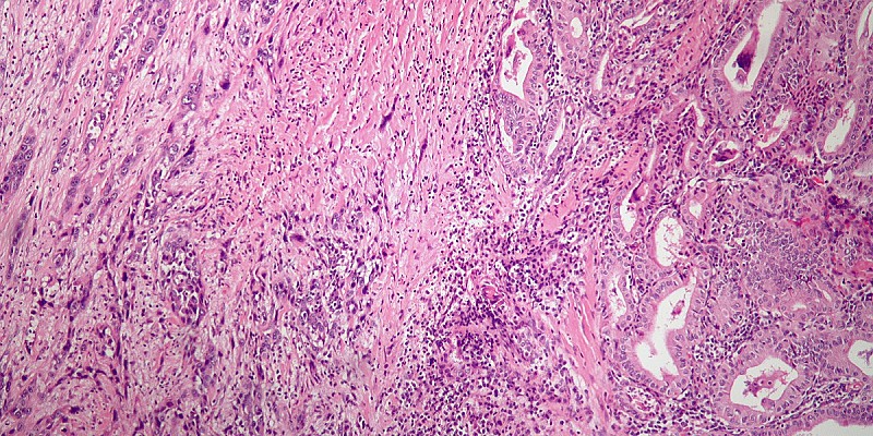 Anaplastic_thyroid_carcinoma_low_mag