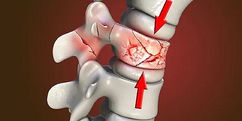frattura vertebrale