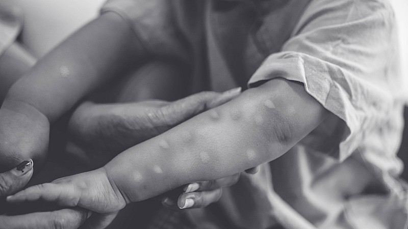 vaiolo scimmie africa