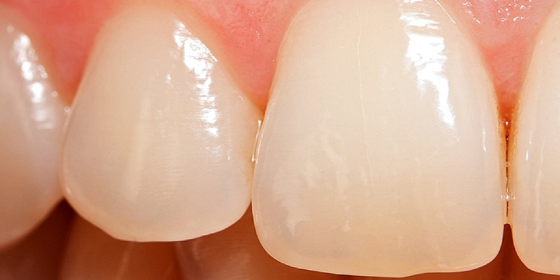 Danni-allo-smalto-dei-denti