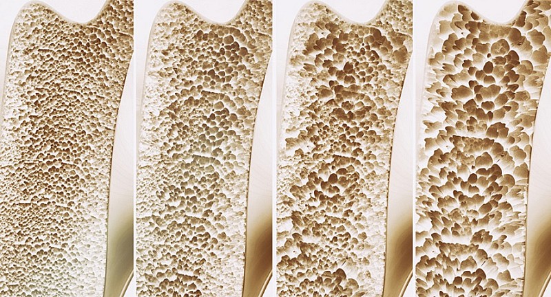 osteoporosi