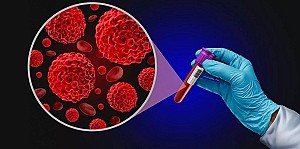 nuova-associazione-di-farmaci-per-mieloma-multiplo-jpeg