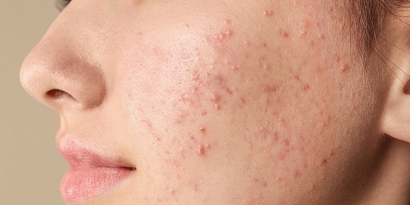 acne pelle