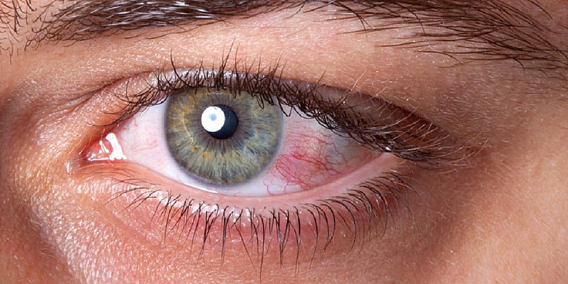Glaucoma