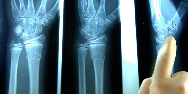 lussazione-polso-diagnosi