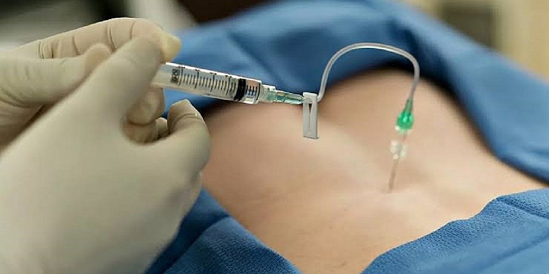 epidurale